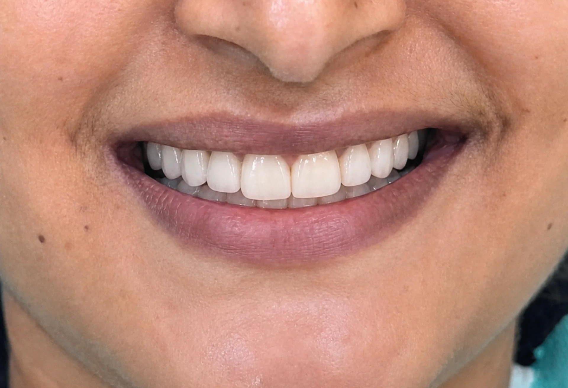 Porcelain veneers: after treatment at Dent Health