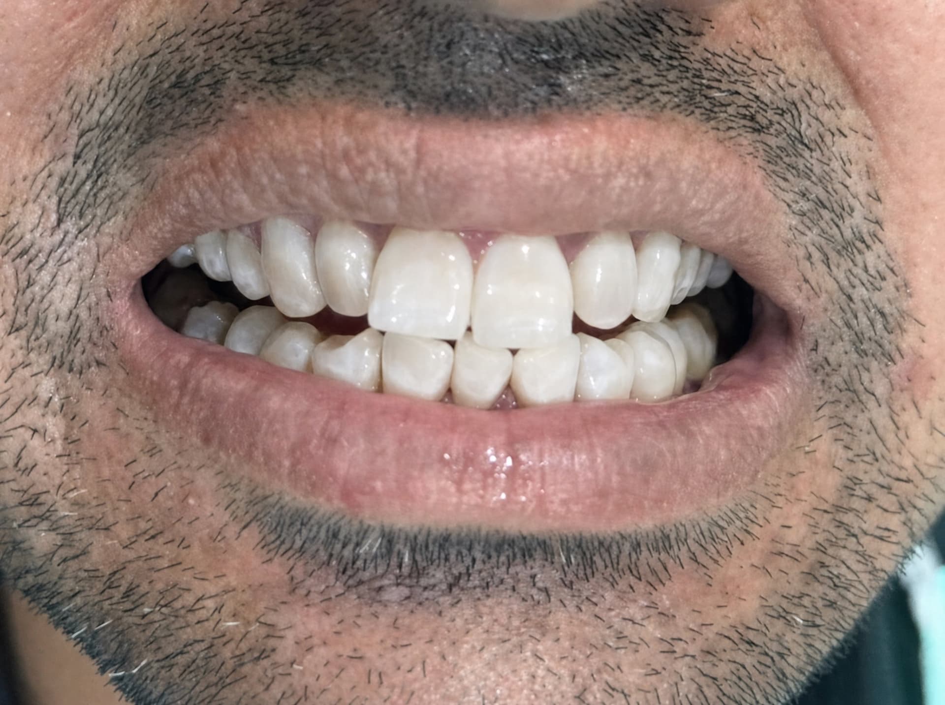 Smile transformation: after treatment at Dent Health